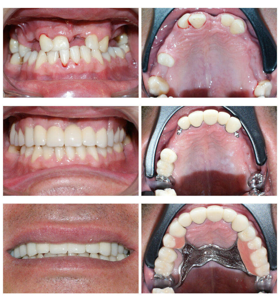 Lucrare fixată pe dinți împreună cu proteză scheletată mobilizabilă = soluția de lux pentru dinți puțini
