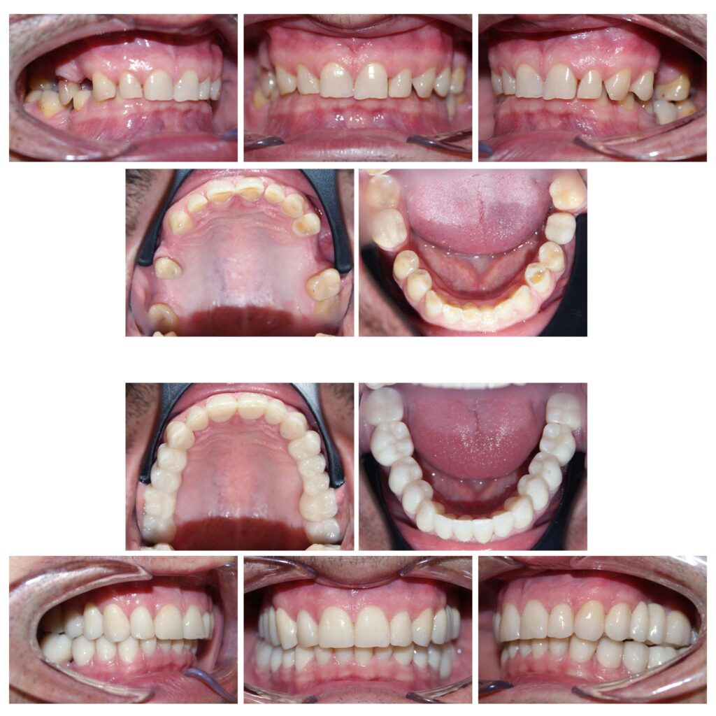 Reabilitare complexă și completă a dinților cu un accent grav de uzură, a dimensiunii verticale de ocluzie și a zâmbetului = restabilirea tuturor funcțiilor naturale