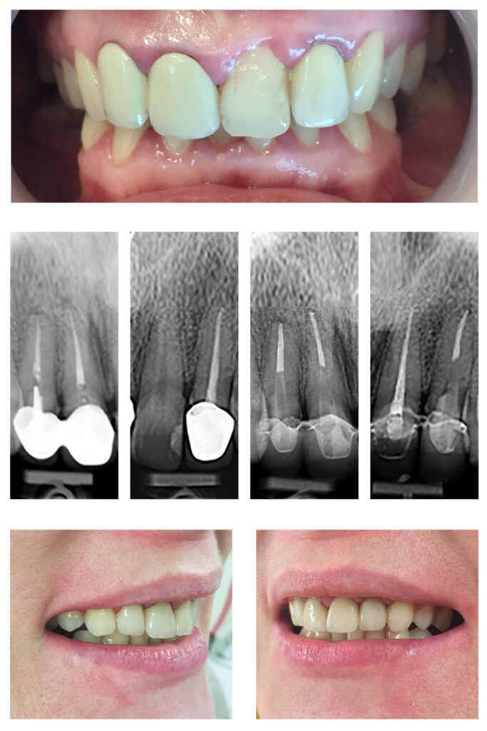 Tratamentele dentare corecte oferă durabilitate lucrărilor dentare perfecte Integrare estetică remarcabilă!