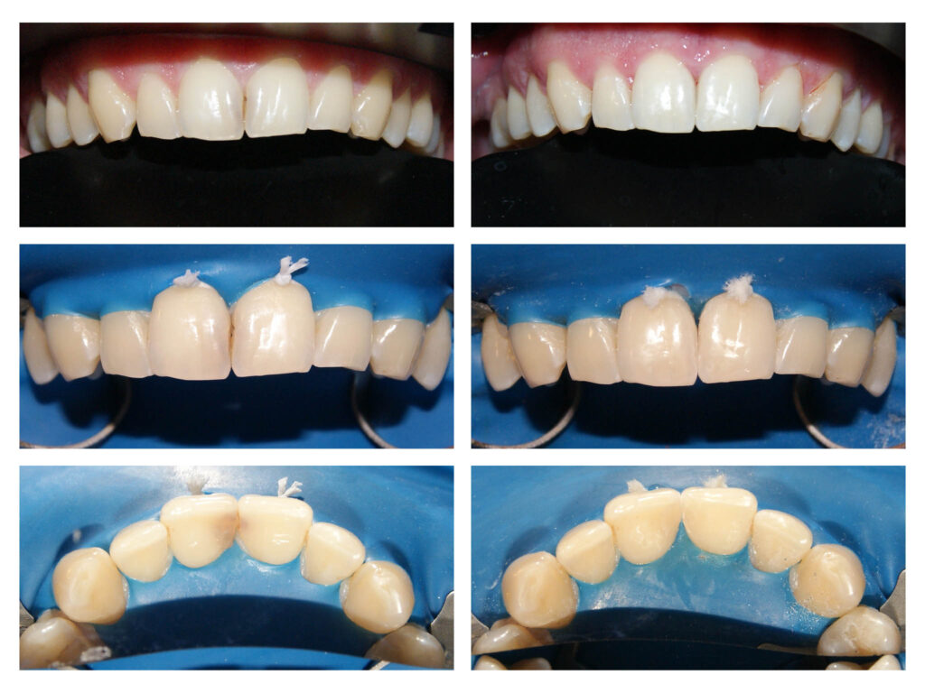 Găsim cea mai potrivită culoare pentru plombițele de pe dinții frontali
