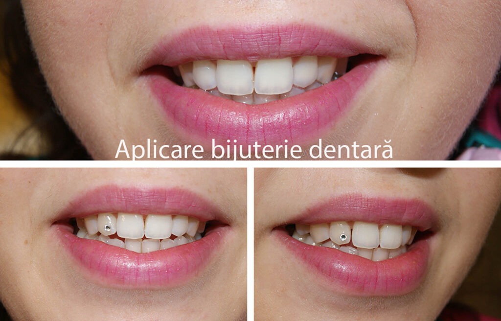 Bijuterie Dentară | Blink – Swarowski