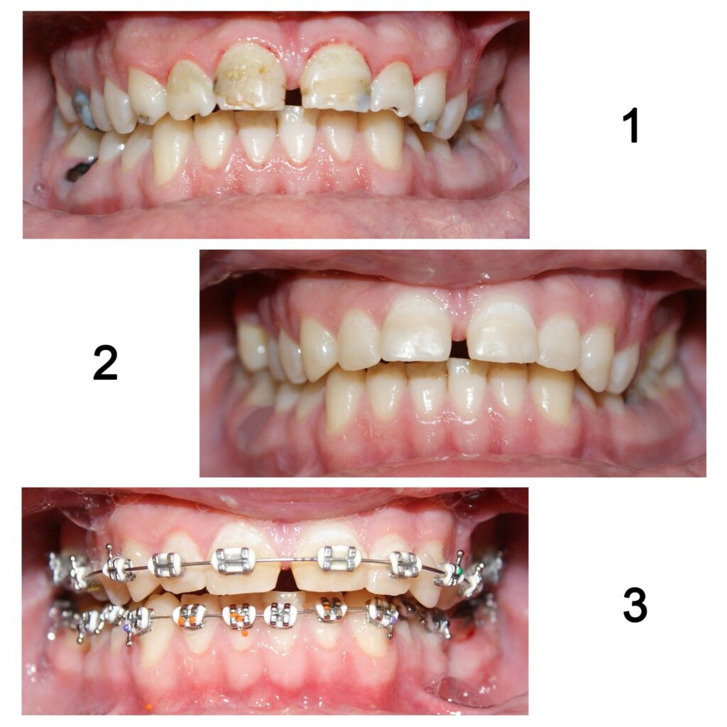 Aparatele ortodontice se aplică doar pe dinții curățați în prealabil. Cariile și resturile radiculare irecuperabile trebuie asanate după cum se vede aici