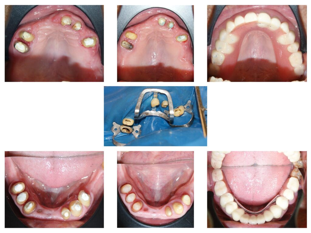 Proteza telescopată  și proteză scheletată aplicate pe dinții tratați corect! Execuția riguroasă oferă stabilitate excelentă.