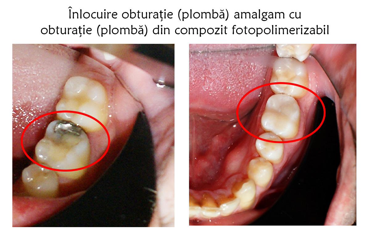 Vechile obturații de amalgam pot fi înlocuite cu succes
