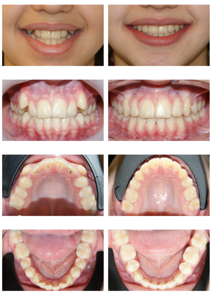 Întrebare “Ce se întâmplă dacă îmi vor fi extrași dinți buni? “Răspuns “Spațiile vor fi închise complet! “ DA, DA, DA! Adesea trebuie să facem extracții în scop ortodontic pentru a crea spațiul necesar alinierii dinților care rămân pe arcadă. În aproximativ 2 ani de tratament ortodontic dinții migrează și închid spațiile astfel încât vei uita că acolo au mai fost vreodată alți dinți