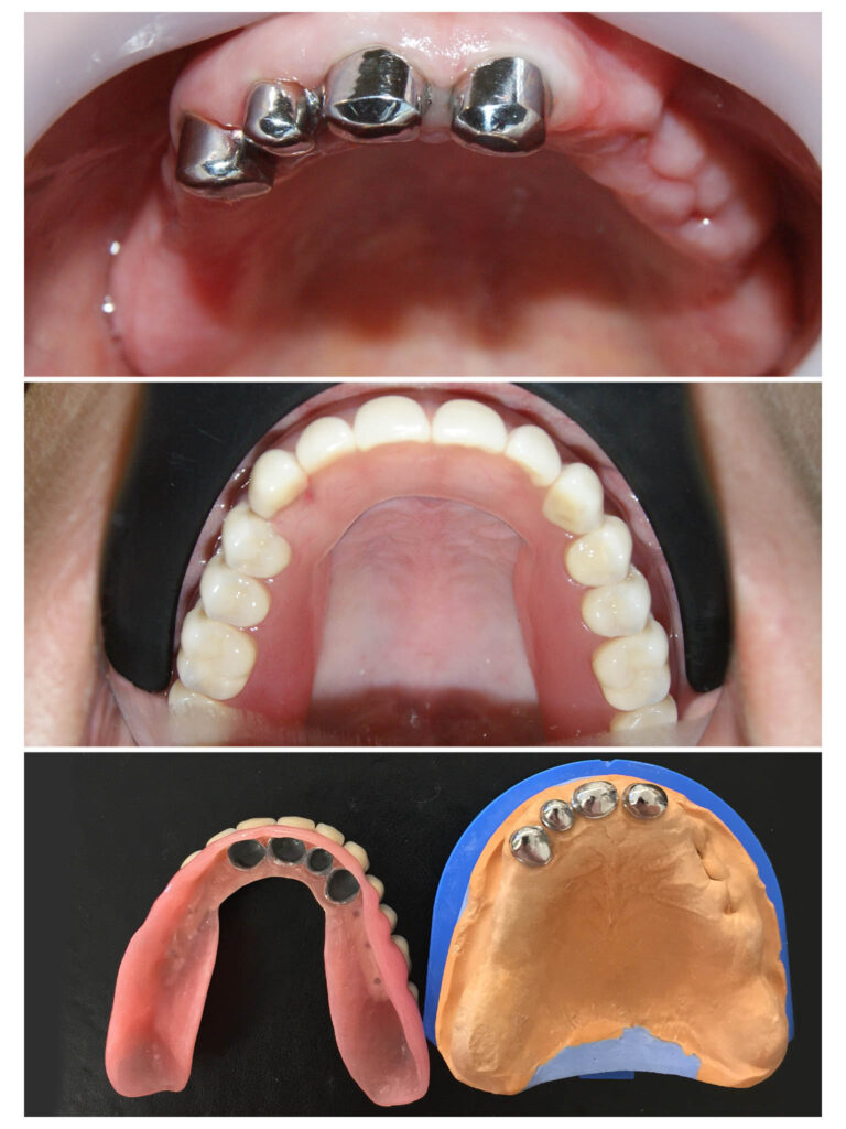 Proteza telescopată – stabilitate perfectă