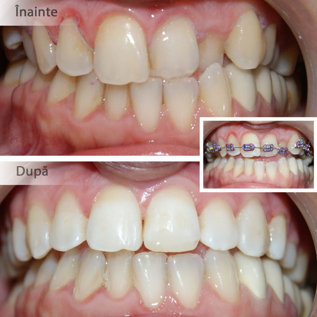 Corectare angrenaj invers