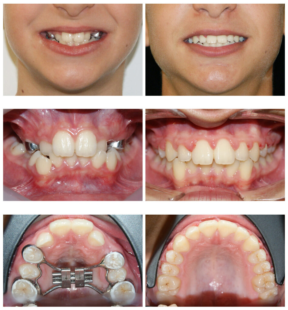 Redeschiderea spațiilor pentru caninii definitivi (a se observa că pe o parte spațiul era închis complet)
