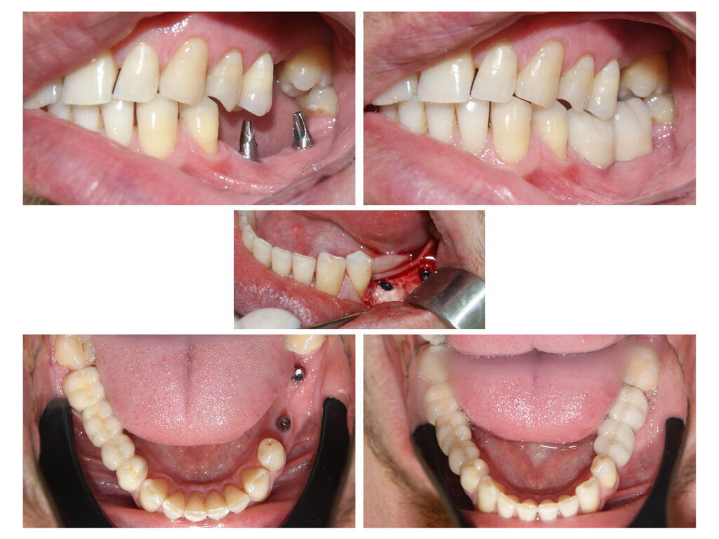 Aplicare implante dentare cu usoara adiție de os artificial si protezarea lor