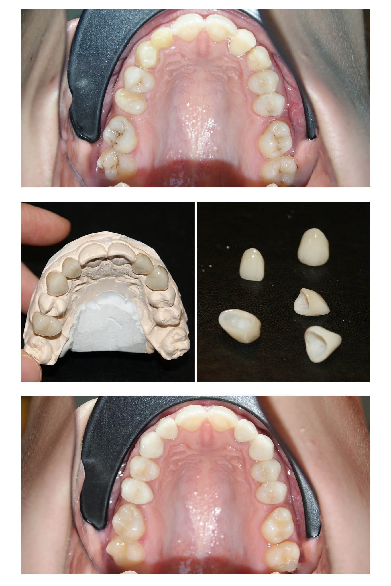 Un caz de o dificultate estestică majoră pe care l-am rezolvat cu succes împreună cu tehnicienii noștri. Am reușit să salvăm toți dinții deși erau destul de mult afectați și ulterior să îi îmbracăm cu coroane solo. Cromatica coronițelor este atât de potrivită încât în final nu se diferențiază de dinții naturali printre care sunt intercalate