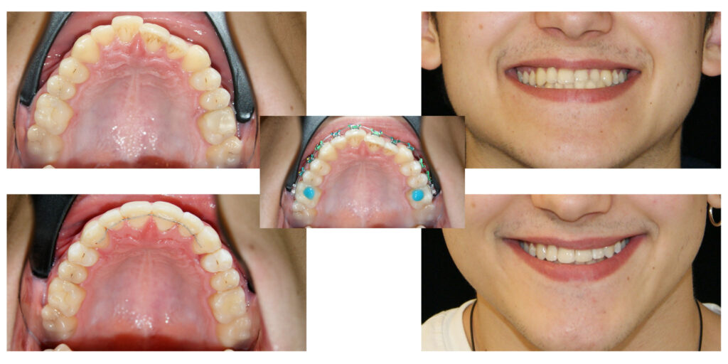 Corectarea ortodontică a angrenajului invers, un zâmbet de mult visat!