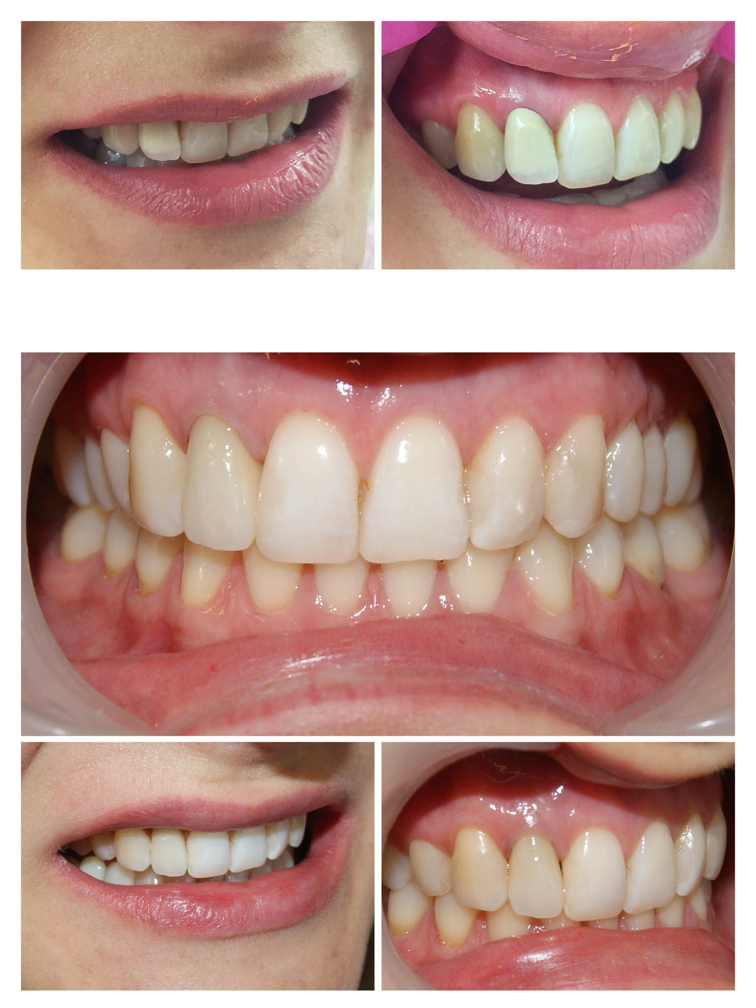 Înlocuire coroană metalo-ceramică cu o coroană de Zirconiu stratificat